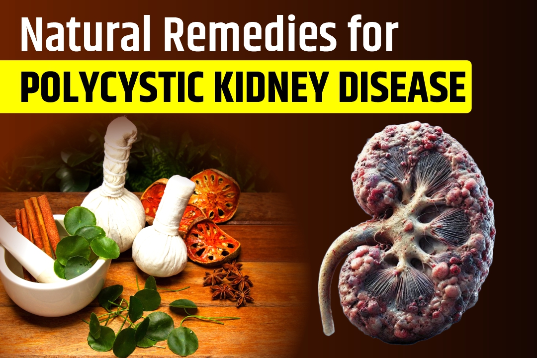 Natural Remedies for Polycystic Kidney Disease